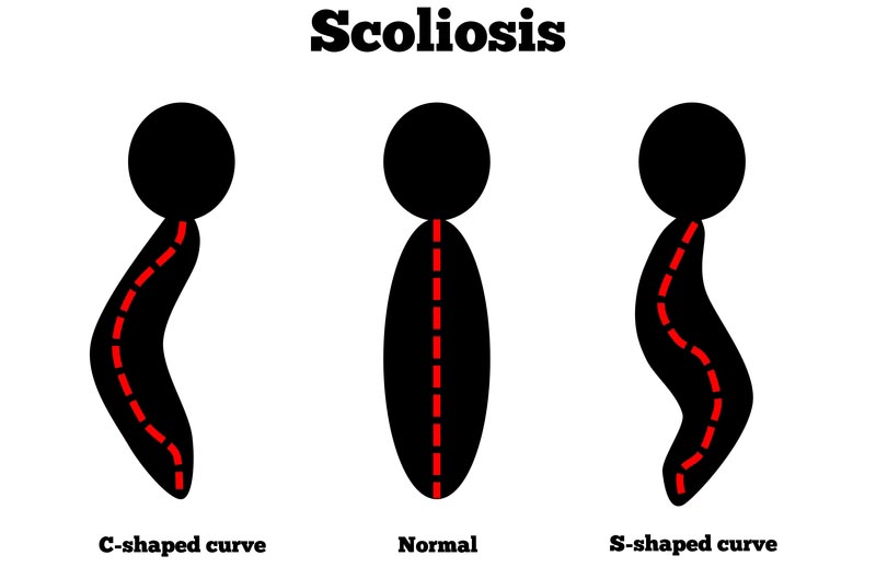 Dover, DE scoliosis treatment